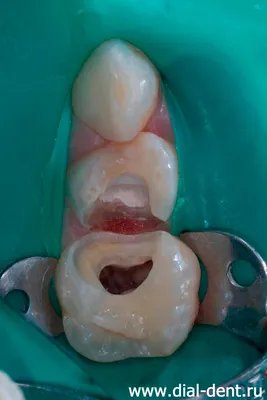 Лечение пульпита | Профилактика пульпита зуба в 32Dent