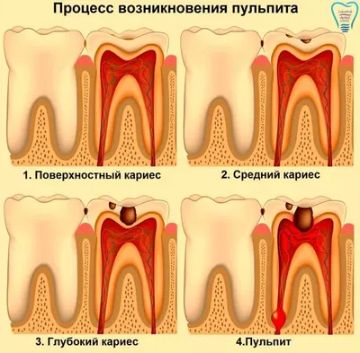Периодонтит молочного зуба: можно ли вылечить? - Евромед Дентал