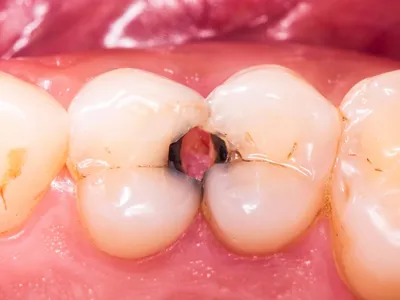 Пульпит зуба: классификация, лечение и удаление