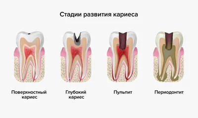Почему нужно лечить молочные зубы