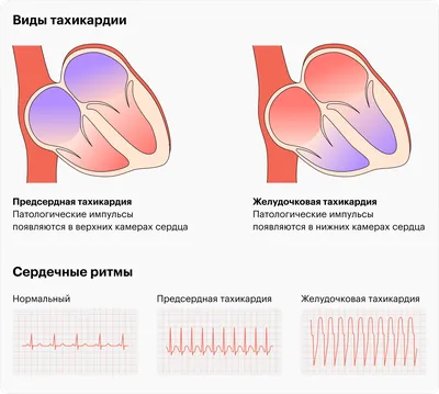 Пульс МРТ в виде сердца на черном…» — создано в Шедевруме
