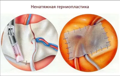 Пупочная грыжа - причины, симптомы, диагностика и лечение