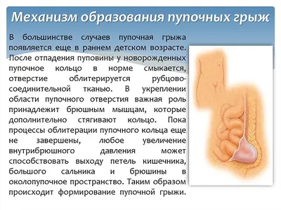 Операция на пупочной грыже — Лечение грыжи живота, операция, удаление грыжи  в Киеве - Хирург Рейзин Денис