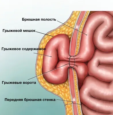 Пупочная грыжа у взрослых как лечить без операции | Dr. Kav Пластический  хирург | Дзен