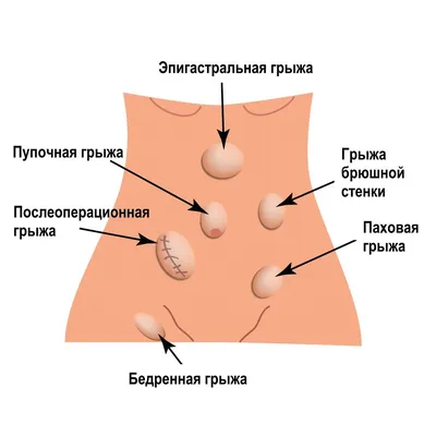 Пупочная грыжа: жалобы, причины появления и методы лечения | gormoniya