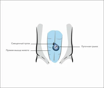 Удаление пупочной грыжи - Инновационная хирургия в Краснодаре, России и СНГ