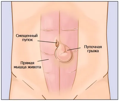 Пупочная грыжа у женщин: симптомы, причины и лечение в Клинике АВС