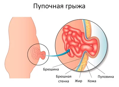 Лечение пупочной грыжи - цена в Санкт-Петербурге | клиника PARADA