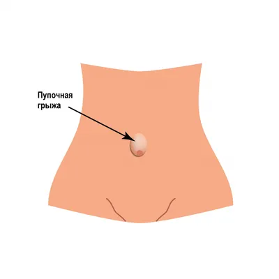Пупочная грыжа у детей | Доктор Стриж | Дзен