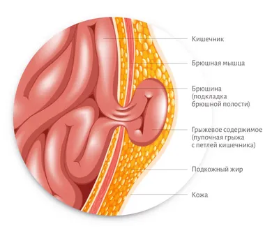 Оперативное лечение грыжи у детей | МЦ Диагност-Плюс | Дзен