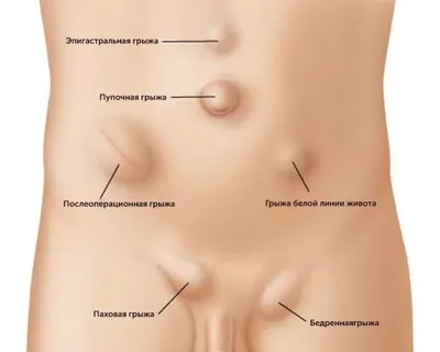 Медицинский центр Медика в Воронеже - 🔎Пупочная грыжа – патология  внутренних органов, при которой кишечник или большой сальник выходят через пупочное  кольцо за пределы брюшной стенки. ⠀ 🤰Чаще всего такое состояние возникает