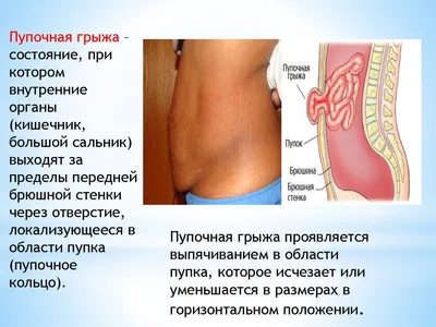 Пупочные грыжи. Герниопластика без натяжения - презентация, доклад, проект