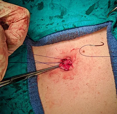 Операция лапароскопия - «Миома матки размером с грейпфрут🍊Мой дневник: от  подготовки до заживления✓Как выглядит живот сразу после лапароскопии и  спустя 2 месяца» | отзывы