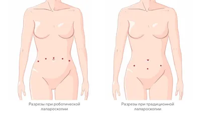 Медицинские Швы На Теле После Лапароскопии — стоковые фотографии и другие  картинки Аппендицит - Аппендицит, Болезнь, Горизонтальный - iStock