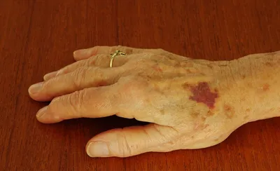 Сенильная пурпура (старческая пурпура): причины и профилактика