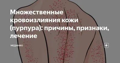 Ребенок с геморрагической сыпью – тема научной статьи по клинической  медицине читайте бесплатно текст научно-исследовательской работы в  электронной библиотеке КиберЛенинка