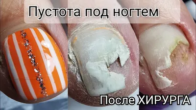 veron_nails_minsk - Пустота под ногтем или - онихолизис😱 ☝️Не тяни с  лечением, обратитесь к специалисту. ☝️ Не давайте возможность грибкам  присоединиться к вам. Удаление онихолизиса с приминением лосьона ADN .  Будьте здоровы!!!❤