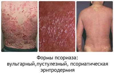 Какого псориаза только не бывает. Формы, виды | Psoriaz.Life | Дзен