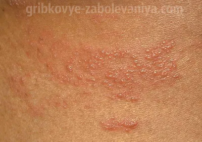 Опоясывающий лишай (опоясывающий герпес, herpes zoster): симптомы и  профилактика