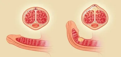 Образования на головке полового члена: виды, симптомы и методы лечения