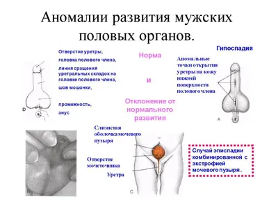 Проявления и лечение грибковых инфекций, эрозии и сыпи на крайней плоти |  Добромед