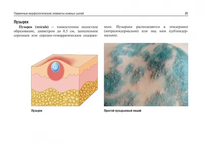 Опоясывающий лишай и ветряная оспа uMEDp