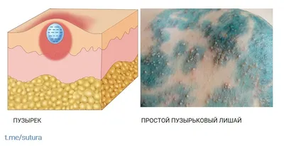 📌 Еще один случай опоясывающего лишая(герпес) клинически проявивщего себя  по ходу седалищного нерва, вертикально. Пузырьковая сыпь на… | Instagram