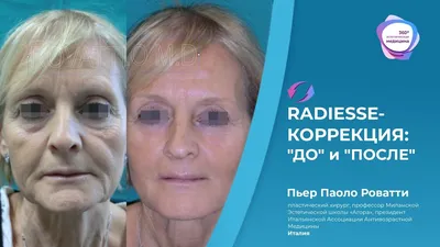 Radiesse (3 мл): 10 фото до и после