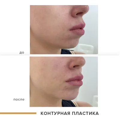 Meso-Radiesse® - Клиника Красоты vipMedicum