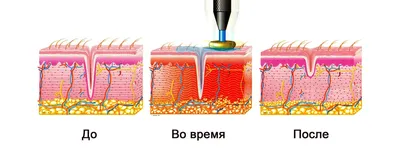 RF лифтинг (радиоволновой лифтинг) от LPG ESTETICA - 2023