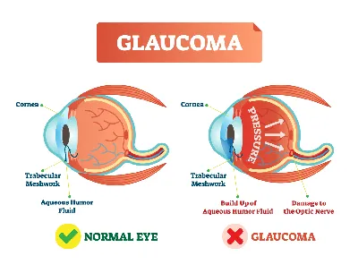 Глазные болезни, которые протекают незаметно, но приводят к слепоте |  Evolutis Clinic | Дзен