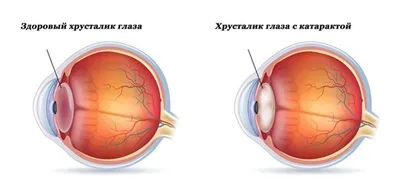 Национальный научный медицинский центр - ❗️❗️ЧЕМ ОПАСНА ГЛАУКОМА? Глаукома  - это одно из наиболее опасных глазных заболеваний при котором зрительный  нерв постепенно погибает, а вместе с ним утрачивается зрение. При глаукоме  практически