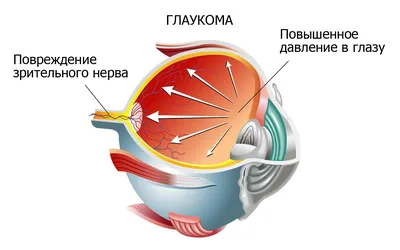 Глаукома. Как не ослепнуть? | ЦЕНТР ЛАЗЕРНОЙ МЕДИЦИНЫ