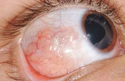Рак глаза симптомы фото фото