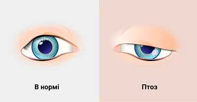 Рак глаза | Evolutis Clinic | Дзен