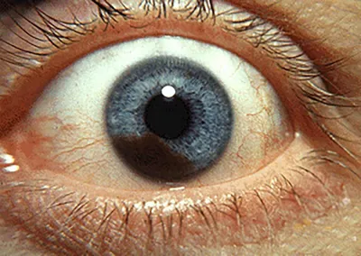 Рак глаза: внутриглазная меланома - Maximed Турция | Guides