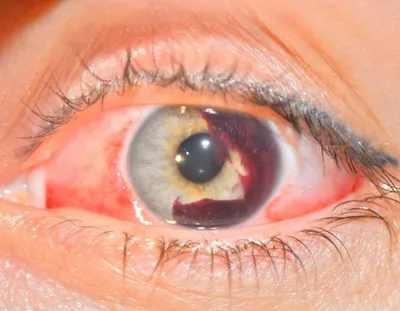 Берегите зрение: врач назвал основные симптомы рака глаз. 8 февраля 2023 г.  Кубанские новости