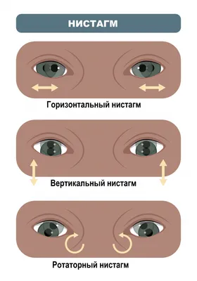 Бельмо на глазу у человека - причины, симптомы и лечение