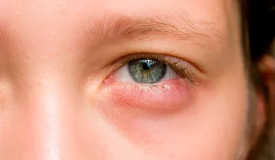 Рак глаза у детей фото фото