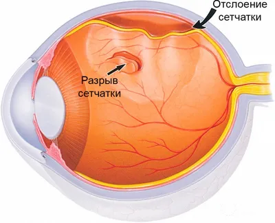 Рак глаза: симптомы, причины, лечение «Ochkov.net»
