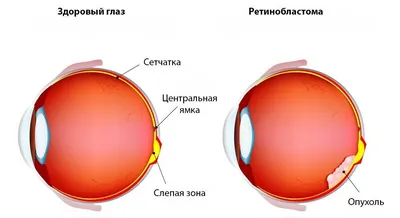 Рак глаза: виды, симптомы и лечение - 11 августа, 2023 Статьи «Кубань 24»