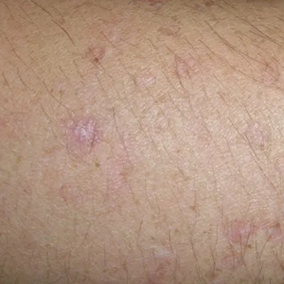 Как выглядит рак кожи — признаки и симптомы меланомы, базалиомы