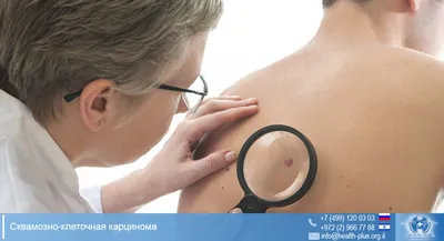 Рак кожи - Школа пациента - УЗ “Минский городской клинический  онкологический центр”