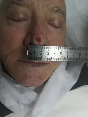 Онкология: немеланомные опухоли кожи - диагностика и лечение в СПб, цена