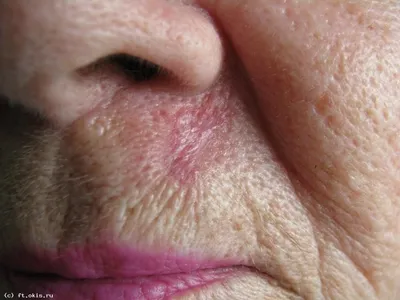 Базалиома кожи — от причин до лечения | Evolutis Clinic | Дзен