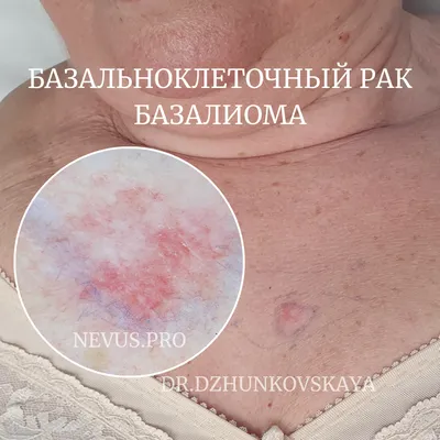 dr.dzhunkovskaya - Проявляется пятном, эрозией, узелком, постепенно  увеличиваясь в размерах, вовлекает в процесс подлежащие ткани. Гематогенные  и лимфогенные метастазы встречайтся крайне редко. Базальноклеточный рак кожи  (карцинома) в основном, имеет ...