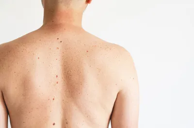 Рак кожи — Операция по методу Мооса в Израиле