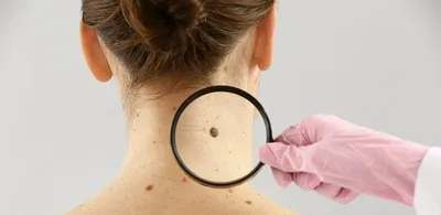 Фото и описание лечения базально-клеточный рак кожи лица методом ФДТ.