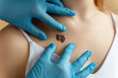 Диагностика рака кожи в Киеве - стоимость лечения | Brennerclinic