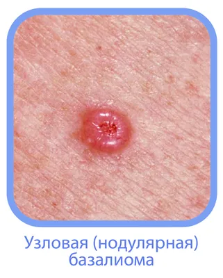 Меланома Юнит Москва - Сегодня предлагаем поговорить об еще одном типе рака  кожа - базалиоме. Базально-клеточный рак или базалиома - один из самых  распространенных типов рака кожи, но одновременно и самый безопасный.